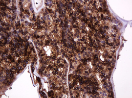 EMA / MUC1 Antibody - IHC of paraffin-embedded Carcinoma of Human thyroid tissue using anti-MUC1 mouse monoclonal antibody.