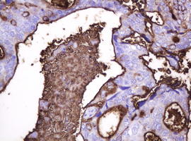 EMA / MUC1 Antibody - IHC of paraffin-embedded Adenocarcinoma of Human breast tissue using anti-MUC1 mouse monoclonal antibody.