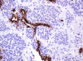 EMA / MUC1 Antibody - IHC of paraffin-embedded Carcinoma of Human lung tissue using anti-MUC1 mouse monoclonal antibody.