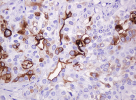 EMA / MUC1 Antibody - IHC of paraffin-embedded Carcinoma of Human bladder tissue using anti-MUC1 mouse monoclonal antibody.