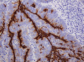 EMA / MUC1 Antibody - IHC of paraffin-embedded Adenocarcinoma of Human endometrium tissue using anti-MUC1 mouse monoclonal antibody.