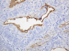 EMA / MUC1 Antibody - IHC of paraffin-embedded Adenocarcinoma of Human endometrium tissue using anti-MUC1 mouse monoclonal antibody.
