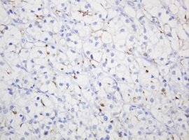 EMA / MUC1 Antibody - IHC of paraffin-embedded Carcinoma of Human kidney tissue using anti-MUC1 mouse monoclonal antibody.