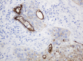 EMA / MUC1 Antibody - IHC of paraffin-embedded Carcinoma of Human lung tissue using anti-MUC1 mouse monoclonal antibody.