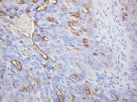 EMA / MUC1 Antibody - IHC of paraffin-embedded Adenocarcinoma of Human ovary tissue using anti-MUC1 mouse monoclonal antibody.
