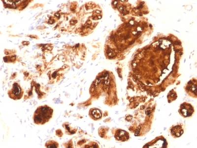 EMA / MUC1 Antibody - Formalin-fixed, paraffin-embedded human Breast Carcinoma stained with MUC1 Mouse Recombinant Monoclonal Antibody (rMUC1/960).