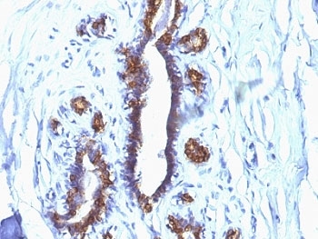 EMA / MUC1 Antibody - Formalin-fixed, paraffin-embedded human breast cancer stained with EMA antibody (SPM132).  This image was taken for the unmodified form of this product. Other forms have not been tested.