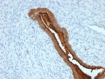 EMA / MUC1 Antibody - Formalin-fixed, paraffin-embedded human endometrial carcinoma stained with anti-MUC-1 antibody (SPM492).  This image was taken for the unmodified form of this product. Other forms have not been tested.