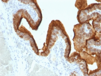 EMA / MUC1 Antibody - Formalin-fixed, paraffin-embedded human ovarian carcinoma stained with anti-MUC1 antibody (SPM493).  This image was taken for the unmodified form of this product. Other forms have not been tested.