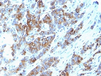 EMA / MUC1 Antibody - Formalin-fixed, paraffin-embedded human breast carcinoma stained with Mucin-1 antibody (SPM533).  This image was taken for the unmodified form of this product. Other forms have not been tested.