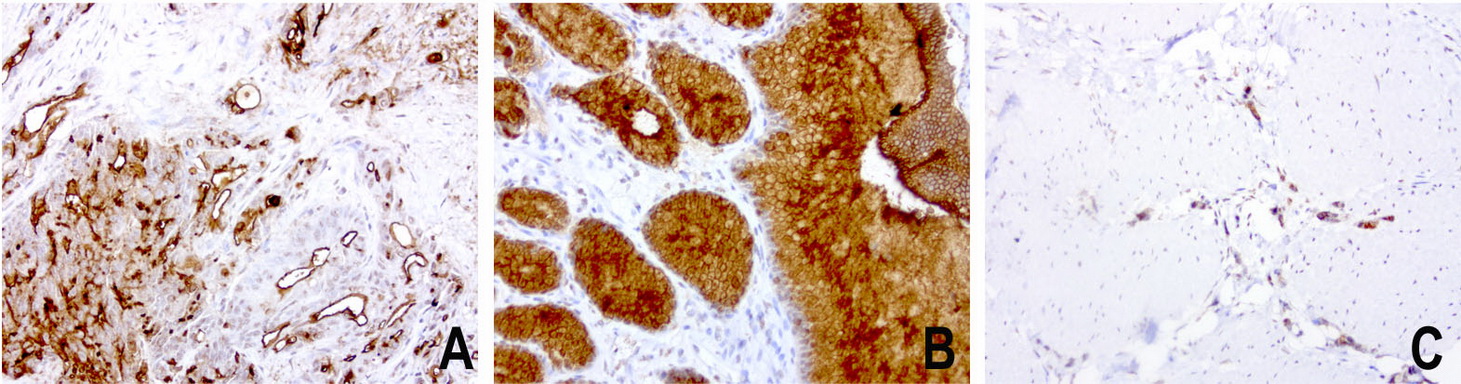 EMA / MUC1 Antibody - Immunohistochemical staining of paraffin-embedded human stomach carcinoma using anti-MUC1. (EMA) mouse monoclonal antibody at 1:200 dilution of1mg/mL using Polink2 Broad HRP DAB for detection.requires heat-induced epitope retrieval with Accel pH8.7 at 110C for 3 min using pressure chamber/cooker. The image is a composite of 3 tumors which show strong membranous and cytoplasmic staining in >75 % tumor cells.