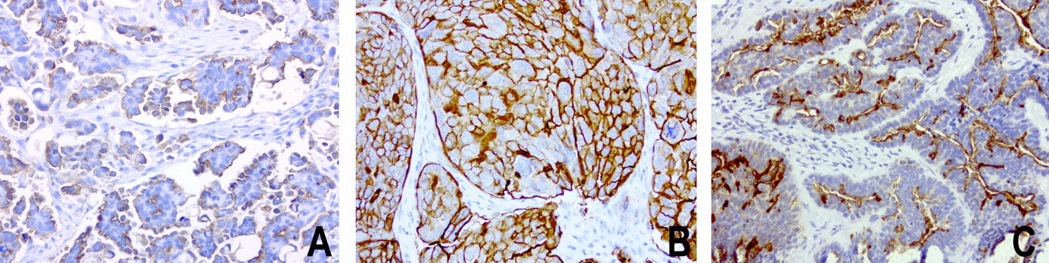 EMA / MUC1 Antibody - Immunohistochemical staining of paraffin-embedded human ovarian carcinoma using anti-MUC1. (EMA) mouse monoclonal antibody at 1:200 dilution of 1mg/mL using Polink2 Broad HRP DAB for detection.requires heat-induced epitope retrieval with Accel pH8.7 at 110C for 3 min using pressure chamber/cooker. The image is a composite of 3 tumors which show strong membranous and weak cytoplasmic staining in >75 % tumor cells.