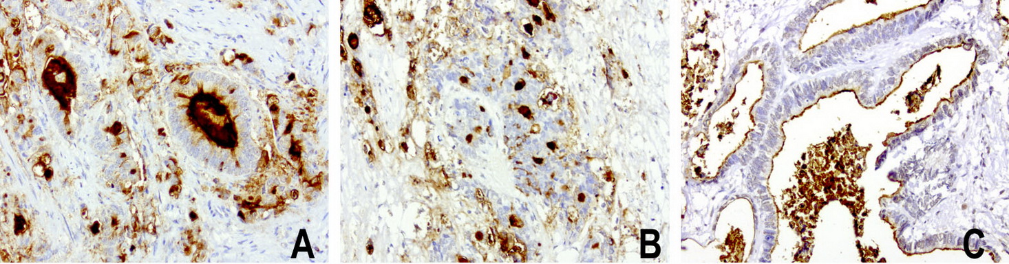 EMA / MUC1 Antibody - Immunohistochemical staining of paraffin-embedded human colon cancer using anti-MUC1(EMA) mouse monoclonal antibody at 1:200 dilution of 1mg/mL using Polink2 Broad HRP DAB for detection.requires heat-induced epitope retrieval with Accel pH8.7 at 110C for 3 min using pressure chamber/cooker. The image is a composite of 3 tumors which show strong membranous and secreted protein however >75 % tumor cells are negative for cytoplasmic staining.