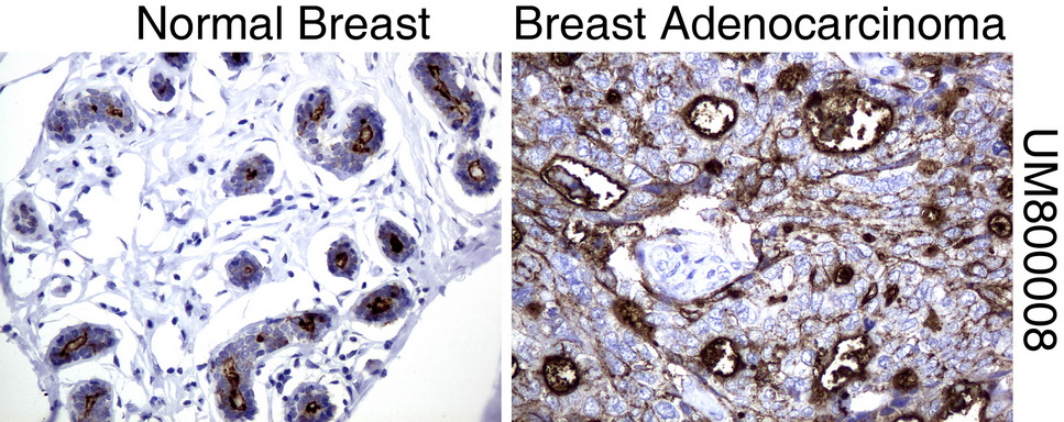 EMA / MUC1 Antibody - Immunohistochemical staining of paraffin-embedded Human normal breast tissue and breast adenocarcinoma tissue using anti-MUC1 mouse monoclonal antibody.  heat-induced epitope retrieval by 1 mM EDTA in 10mM Tris, pH8.0, 120C for 3min)
