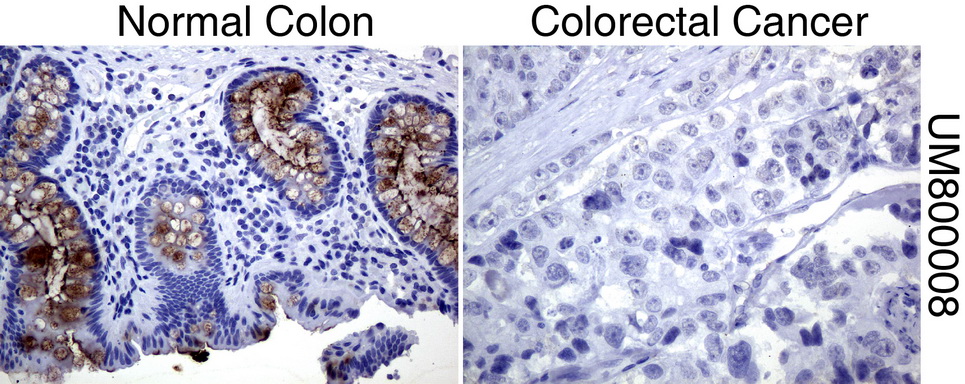 EMA / MUC1 Antibody - Immunohistochemical staining of paraffin-embedded Human normal colon tissue and colorectal cancer tissue using anti-MUC1 mouse monoclonal antibody.  heat-induced epitope retrieval by 1 mM EDTA in 10mM Tris, pH8.0, 120C for 3min)