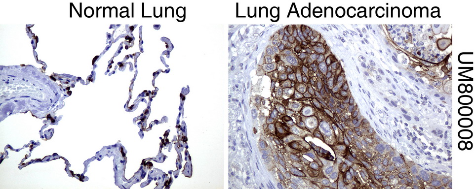 EMA / MUC1 Antibody - Immunohistochemical staining of paraffin-embedded Human normal lung tissue and lung adenocarcinoma tissue using anti-MUC1 mouse monoclonal antibody.  heat-induced epitope retrieval by 1 mM EDTA in 10mM Tris, pH8.0, 120C for 3min)