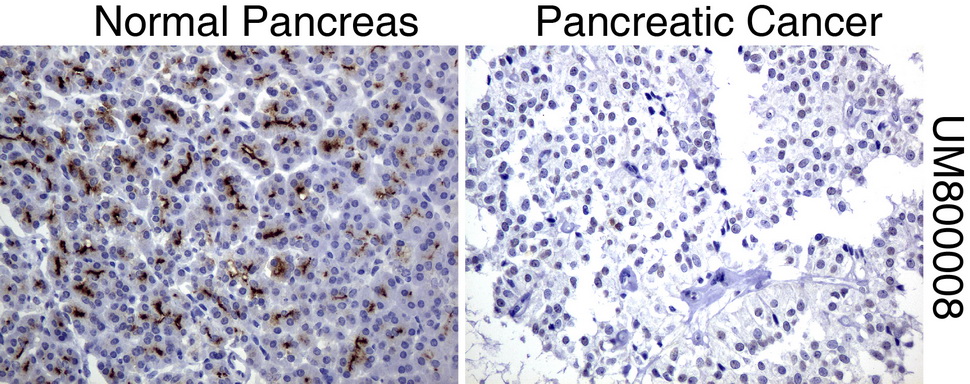 EMA / MUC1 Antibody - Immunohistochemical staining of paraffin-embedded Human normal pancreas tissue and pancreatic cancer tissue using anti-MUC1 mouse monoclonal antibody.  heat-induced epitope retrieval by 1 mM EDTA in 10mM Tris, pH8.0, 120C for 3min)