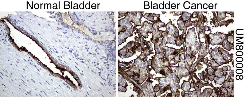 EMA / MUC1 Antibody - Immunohistochemical staining of paraffin-embedded Human normal bladder tissue and bladder cancer tissue using anti-MUC1 mouse monoclonal antibody.  heat-induced epitope retrieval by 1 mM EDTA in 10mM Tris, pH8.0, 120C for 3min)