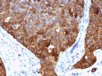 EMA / MUC1 Antibody - IHC testing of FFPE human colon carcinoma with MUC1 antibody (clone VU-4H5). HIER: requires steaming of sections in 10mM citrate buffer, pH 6, for 10-20 min and allow to cool before testing.