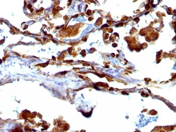 EMA / MUC1 Antibody - IHC testing of FFPE human lung carcinoma with MUC1 antibody (clone VU-4H5). HIER: requires steaming of sections in 10mM citrate buffer, pH 6, for 10-20 min and allow to cool before testing.