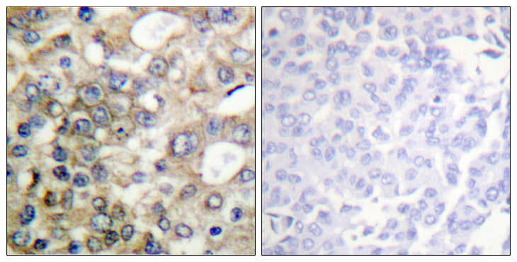 EMA / MUC1 Antibody - Immunohistochemistry analysis of paraffin-embedded human breast carcinoma, using CD227/MUC1 (Phospho-Tyr1229) Antibody. The picture on the right is blocked with the phospho peptide.