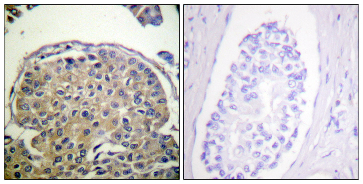 EMA / MUC1 Antibody - Immunohistochemistry analysis of paraffin-embedded human breast carcinoma, using CD227/Mucin 1 (Phospho-Tyr1243) Antibody. The picture on the right is blocked with the phospho peptide.