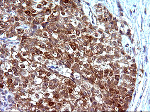 EMC8 / COX4NB Antibody - IHC of paraffin-embedded Carcinoma of Human liver tissue using anti-COX4NB mouse monoclonal antibody. (Heat-induced epitope retrieval by 10mM citric buffer, pH6.0, 120°C for 3min).