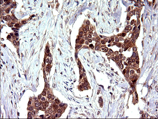 EMC8 / COX4NB Antibody - IHC of paraffin-embedded Carcinoma of Human bladder tissue using anti-COX4NB mouse monoclonal antibody. (Heat-induced epitope retrieval by 10mM citric buffer, pH6.0, 120°C for 3min).