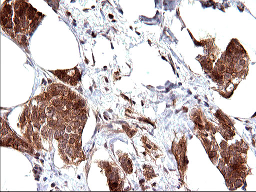 EMC8 / COX4NB Antibody - IHC of paraffin-embedded Adenocarcinoma of Human breast tissue using anti-COX4NB mouse monoclonal antibody. (Heat-induced epitope retrieval by 10mM citric buffer, pH6.0, 120°C for 3min).