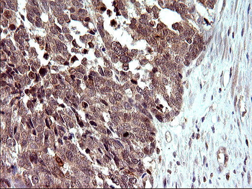 EMC8 / COX4NB Antibody - IHC of paraffin-embedded Adenocarcinoma of Human colon tissue using anti-COX4NB mouse monoclonal antibody. (Heat-induced epitope retrieval by 10mM citric buffer, pH6.0, 120°C for 3min).