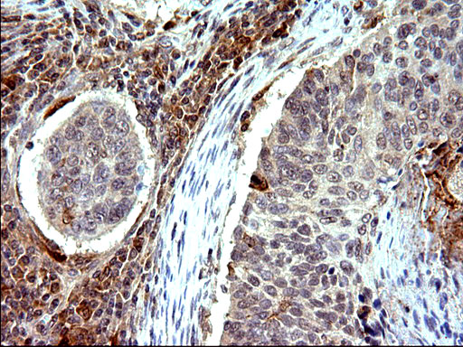 EMC8 / COX4NB Antibody - IHC of paraffin-embedded Carcinoma of Human lung tissue using anti-COX4NB mouse monoclonal antibody. (Heat-induced epitope retrieval by 10mM citric buffer, pH6.0, 120°C for 3min).