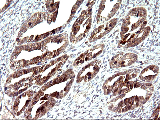 EMC8 / COX4NB Antibody - IHC of paraffin-embedded Adenocarcinoma of Human ovary tissue using anti-COX4NB mouse monoclonal antibody. (Heat-induced epitope retrieval by 10mM citric buffer, pH6.0, 120°C for 3min).