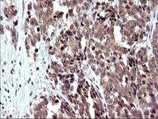 EMC8 / COX4NB Antibody - IHC of paraffin-embedded Adenocarcinoma of Human colon tissue using anti-COX4NB mouse monoclonal antibody. (Heat-induced epitope retrieval by 10mM citric buffer, pH6.0, 120°C for 3min).