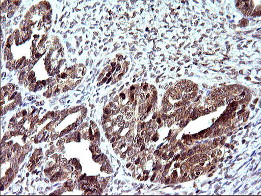 EMC8 / COX4NB Antibody - IHC of paraffin-embedded Adenocarcinoma of Human ovary tissue using anti-COX4NB mouse monoclonal antibody. (Heat-induced epitope retrieval by 10mM citric buffer, pH6.0, 120°C for 3min).
