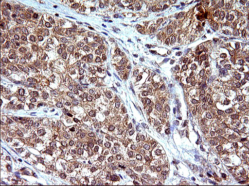 EMC8 / COX4NB Antibody - IHC of paraffin-embedded Carcinoma of Human pancreas tissue using anti-COX4NB mouse monoclonal antibody. (Heat-induced epitope retrieval by 10mM citric buffer, pH6.0, 120°C for 3min).