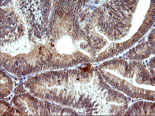 EMC8 / COX4NB Antibody - IHC of paraffin-embedded Adenocarcinoma of Human endometrium tissue using anti-COX4NB mouse monoclonal antibody. (Heat-induced epitope retrieval by 10mM citric buffer, pH6.0, 120°C for 3min).
