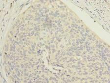 EMC8 / COX4NB Antibody - Immunohistochemistry of paraffin-embedded human cervical cancer using antibody at dilution of 1:100.