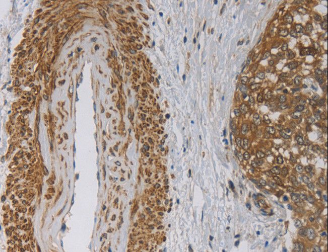 EMC8 / COX4NB Antibody - Immunohistochemistry of paraffin-embedded Human cervical cancer using EMC8 Polyclonal Antibody at dilution of 1:30.