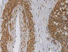 EMC8 / COX4NB Antibody - Immunohistochemistry of paraffin-embedded Human cervical cancer using EMC8 Polyclonal Antibody at dilution of 1:30.