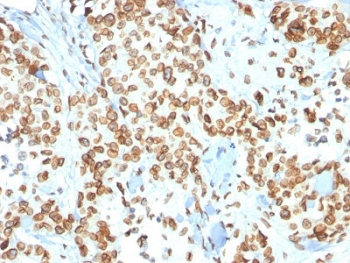 EMD / Emerin Antibody - IHC testing of FFPE human breast carcinoma with Emerin antibody (clone EMD/2167). Required HIER: boiling tissue sections in 10mM citrate buffer, pH 6, for 10-20 min and allow to cool prior to staining.