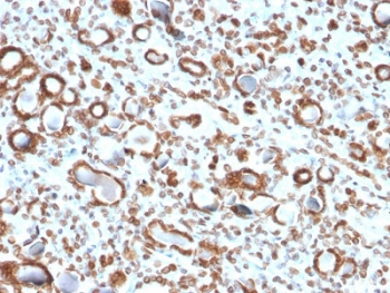 EMD / Emerin Antibody - IHC testing of FFPE human renal cell carcinoma with Emerin antibody (clone EMD/2167). Required HIER: boiling tissue sections in 10mM citrate buffer, pH 6, for 10-20 min and allow to cool prior to staining.