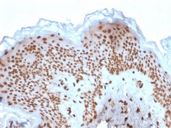 EMD / Emerin Antibody - IHC testing of FFPE human basal cell carcinoma with Emerin antibody (clone EMD/2167). Required HIER: boiling tissue sections in 10mM citrate buffer, pH 6, for 10-20 min and allow to cool prior to staining.
