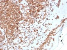 EMD / Emerin Antibody - IHC testing of FFPE human basal cell carcinoma with Emerin antibody (clone EMD/2168). Required HIER: boiling tissue sections in 10mM citrate buffer, pH 6, for 10-20 min and allow to cool prior to staining.