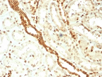 EMD / Emerin Antibody - IHC testing of FFPE human renal cell carcinoma with Emerin antibody (clone EMD/2168). Required HIER: boiling tissue sections in 10mM citrate buffer, pH 6, for 10-20 min and allow to cool prior to staining.