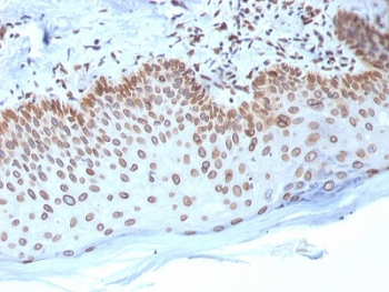 EMD / Emerin Antibody - IHC testing of FFPE human breast carcinoma with Emerin antibody (clone EMD/2168). Required HIER: boiling tissue sections in 10mM citrate buffer, pH 6, for 10-20 min and allow to cool prior to staining.