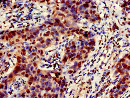 EMD / Emerin Antibody - Immunohistochemistry of paraffin-embedded human bladder cancer using EMD Antibody at dilution of 1:100