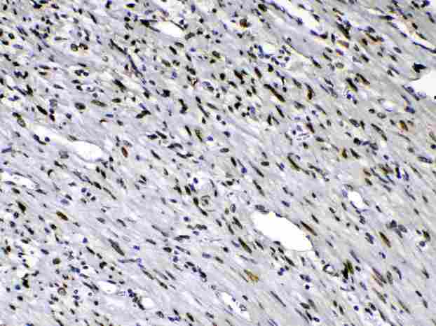 EMD / Emerin Antibody - Emerin was detected in paraffin-embedded sections of human intetsinal cancer tissues using rabbit anti- Emerin Antigen Affinity purified polyclonal antibody
