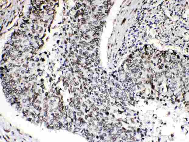 EMD / Emerin Antibody - Emerin was detected in paraffin-embedded sections of human lung cancer tissues using rabbit anti- Emerin Antigen Affinity purified polyclonal antibody