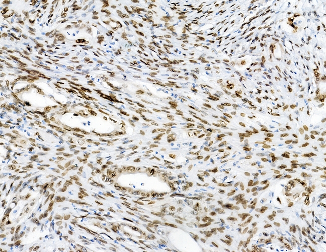 EMD / Emerin Antibody - IHC analysis of Emerin using anti-Emerin antibody. Emerin was detected in paraffin-embedded section of human colon cancer tissues. Heat mediated antigen retrieval was performed in citrate buffer (pH6, epitope retrieval solution) for 20 mins. The tissue section was blocked with 10% goat serum. The tissue section was then incubated with 1µg/ml rabbit anti-Emerin Antibody overnight at 4°C. Biotinylated goat anti-rabbit IgG was used as secondary antibody and incubated for 30 minutes at 37°C. The tissue section was developed using Strepavidin-Biotin-Complex (SABC) with DAB as the chromogen.