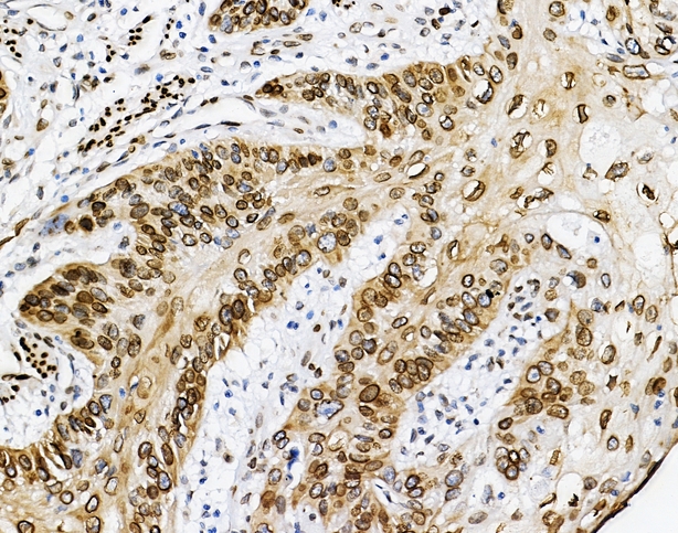EMD / Emerin Antibody - IHC analysis of Emerin using anti-Emerin antibody. Emerin was detected in paraffin-embedded section of human oesophagus squama cancer tissues. Heat mediated antigen retrieval was performed in citrate buffer (pH6, epitope retrieval solution) for 20 mins. The tissue section was blocked with 10% goat serum. The tissue section was then incubated with 1µg/ml rabbit anti-Emerin Antibody overnight at 4°C. Biotinylated goat anti-rabbit IgG was used as secondary antibody and incubated for 30 minutes at 37°C. The tissue section was developed using Strepavidin-Biotin-Complex (SABC) with DAB as the chromogen.